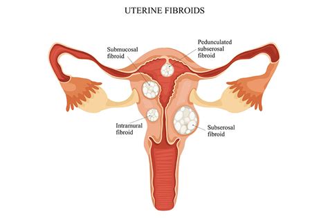 Uterine Fibroids Symptoms Causes And Its Types Birla Fertility And Ivf