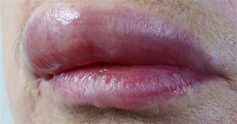 Swollen Lips Causes And Treatment Swollen Lips Lip Allergy Lip