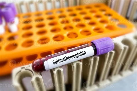 Sulfmethemoglobin Blood Test The Complex Formed By The Reaction Of A