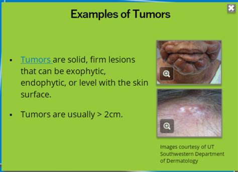 Skin Lesions Flashcards Quizlet