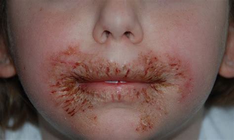 1000 Images About Kids Skin Problems On Pinterest Skin Rash Baby