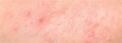 Identify Different Types Of Skin Rashes And Causes Skin