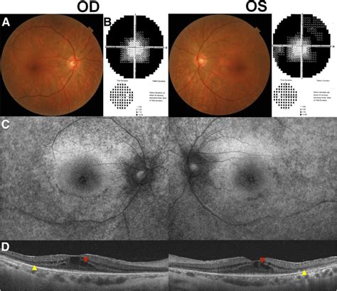 Fundus Photographs A Visual Field Results B Fundus Download