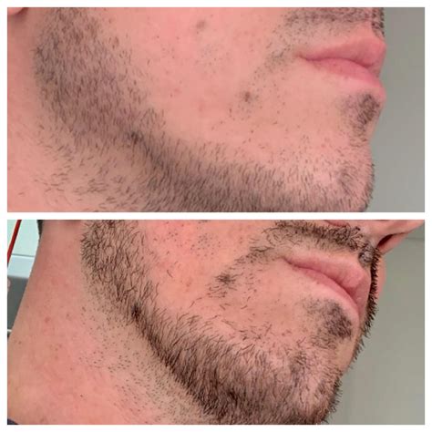Facial hair growth is a big deal for a lot of guys and getting that perfect beard, mustache or goatee is no easy task. I posted the top photo one week ago asking for opinions ...