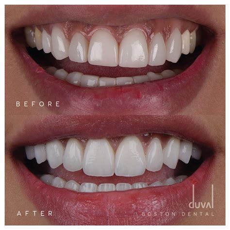 Before & After Images from Our Patients in Boston, MA | Boston Dental