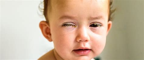 Zapalenie spojówek u dzieci przyczyny objawy leczenie portal DOZ pl