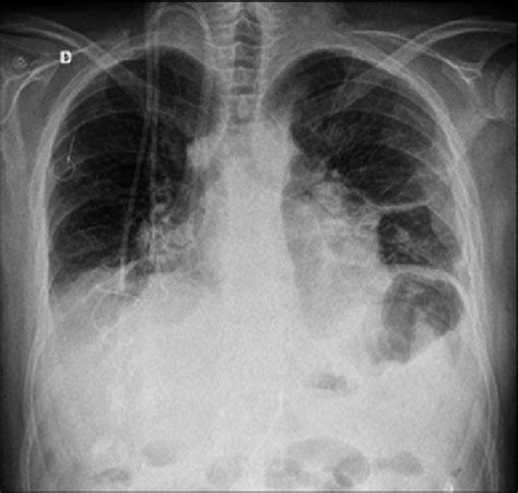 Radiograf A De T Rax Derrame Pleural Bilateral Ascenso De Ambos