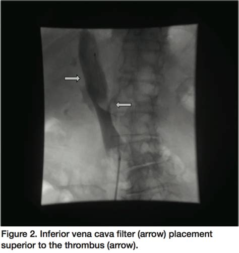 Rheolytic Thrombectomy After Inferior Vena Cava Filter Placement To
