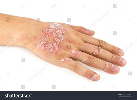 Psoriasis Vulgaris On Male Hand Finger Stock Photo