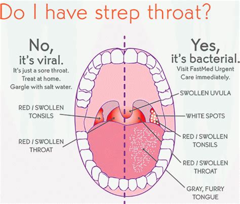 Strep Throat Symptoms The Best Antibiotics For Strep Throat