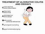 Images of Medical Treatment Of Ulcerative Colitis