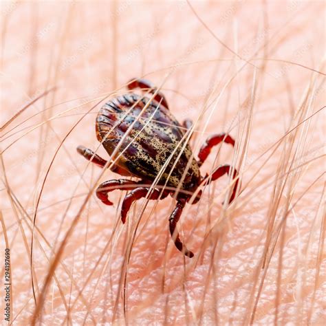 Encephalitis Tick Insect Crawling On Skin Encephalitis Virus Or Lyme
