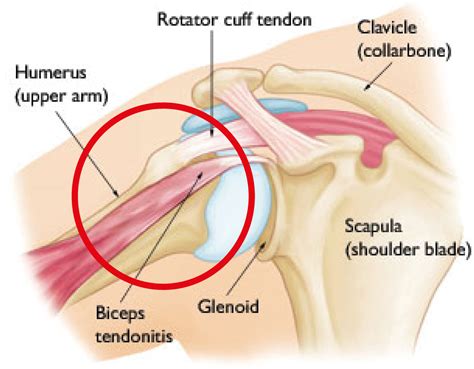 Supraspinatus tendon is most often involved. Bigger Biceps: Enter the Rotator Cuff | TRUworkout