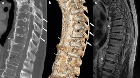 2 Crohns Disease Related To Ankylosing Spondylitis Sagittal