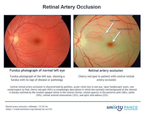 Retinal Artery Occlusion With Pale Retina And Cherry Red Spot In