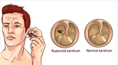 Ruptured Eardrum As Related To Eardrum Pictures