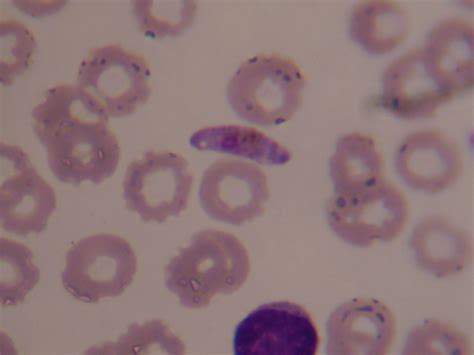 Plasmodium Falciparum Gametozyten Doccheck