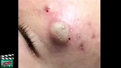 30 Pimple Popping Huge Cyst Explosion Really Just For Hard Ones Youtube