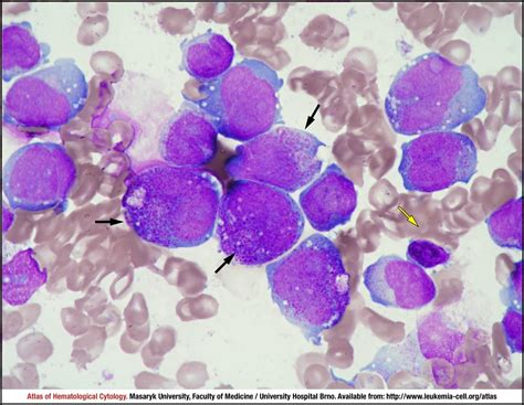Chronic Myeloid Leukaemia Cml Bcr Abl1 Positive Blast Phase