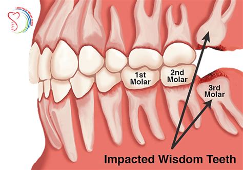 Diagram Of Teeth With Wisdom Teeth Teeth Poster
