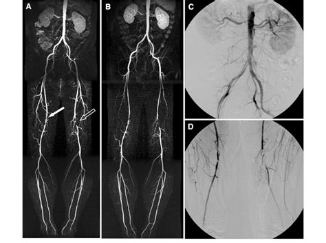 64 Year Old Man Referred For Ce Mra For Symptomatic Peripheral Arterial