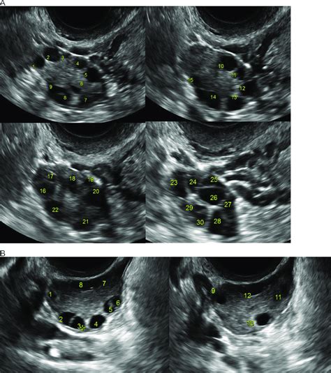 Serial Transvaginal Ultrasound Images Evaluated Follicle Number Per