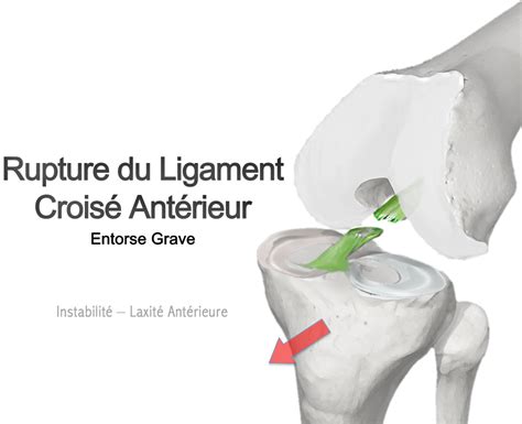 Rupture du ligament croisé antérieur LCA Groupe Clinique Drouot