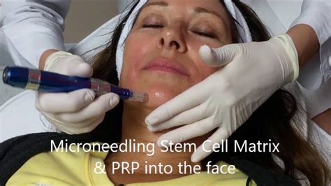 Stem Cell Facial Prp Facial Microneedling Hyperbaric Chamber Youtube