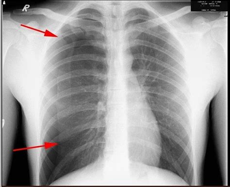 Large Right Sided Spontaneous Pneumothorax Lung Surface Is Pointed By