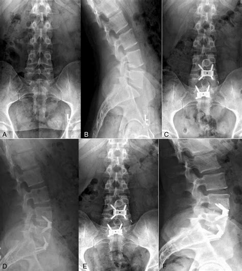 Anteroposterior A And Lateral B Standard X Rays Of L4 L5l5 S1