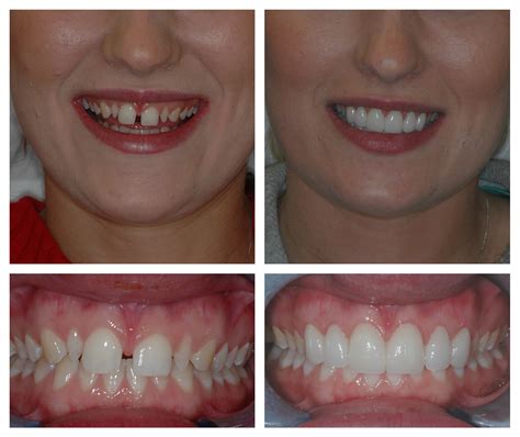 Dental Veneers Surrey Chipped And Broken Teeth Treatment