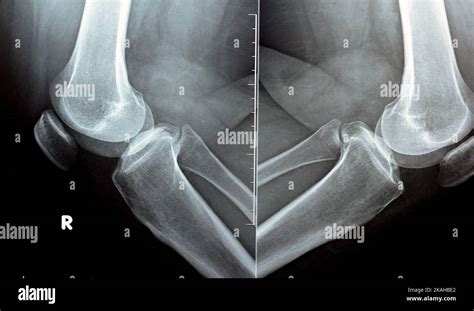 Plain X Ray On Knee Joint Showing Joint Space Narrowing And Subchondral