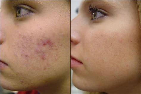 Acne Scars Causes Prevention And Treatment Waxelene