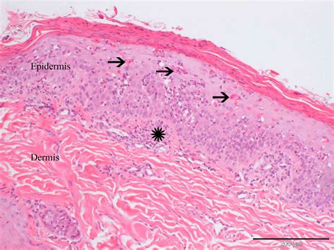 Erythema Multiforme In A Labrador Retriever Case Study Cytopath