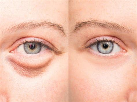 5 Tips To Overcome Puffy Eyes