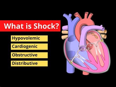 An review of the definitions, presentation, and management of sepsis and septic shock, including fluid and pressor recommendations. What is Shock? - YouTube