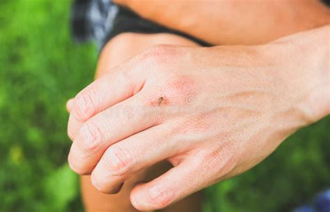 Mosquito Sitting On The Hand Insects Bite In The Summer Dangerous