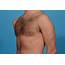 Chest Contouring With Pectoral Augmentation In Dallas Texas  Dr