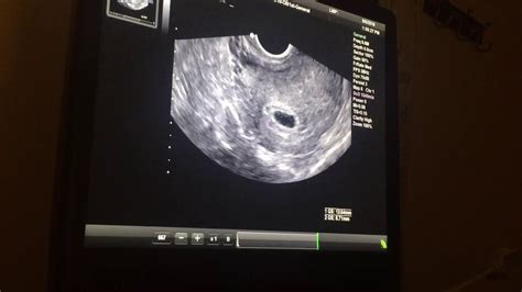 Pregnancy Ultrasound 5 Weeks And 5 Days Youtube