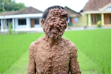 It is a very common cause of. Neurofibromatosis sufferer Slamet pictured with thousands ...