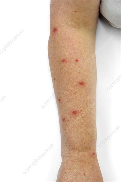Scabies Infection On The Skin Stock Image C0183597 Science Photo Library