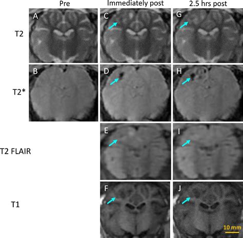 Transcranial Magnetic Resonance Guided Histotripsy For Brain Surgery