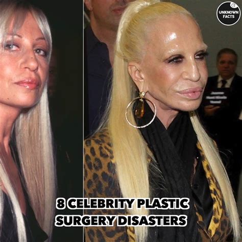 Plastic Surgery Disasters Before And After