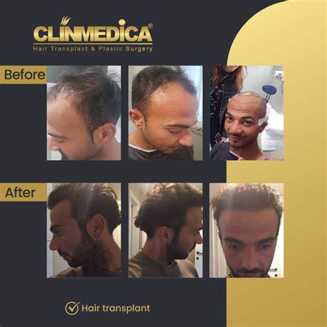 Hair Transplant Before And After Results ClinMedica Turkey