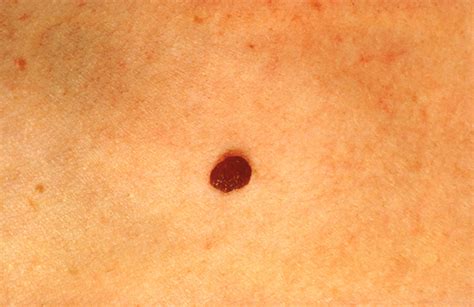 Medical Pictures Info Cancer Mole