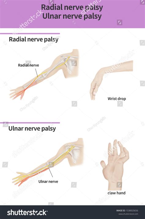 Radial Nerve Palsy Ulnar Nerve Palsy Stock Illustration 1538820656