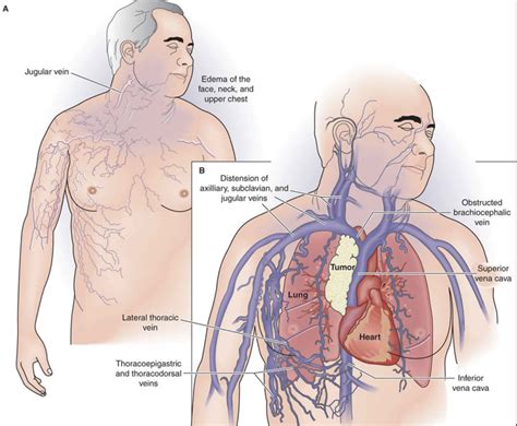 Superior Vena Cava Anatomy Function And Superior Vena Cava Syndrome