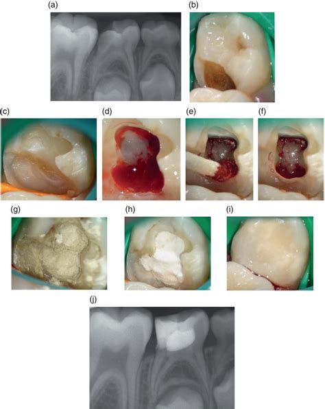 Materials And Clinical Techniques For Endodontic Therapy Of Deciduous