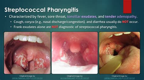 Streptococcal Pharyngitis Youtube