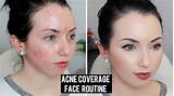 Best Makeup Coverage For Acne Photos
